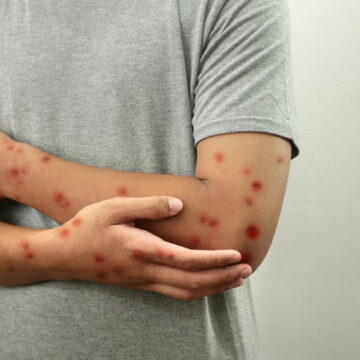 Registra Jalisco 55 casos de Mpox; 5 de ellos en Puerto Vallarta